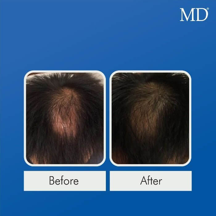 Before and after using MD® Follicle Energizer – visible hair regrowth and reduced bald spot at the crown in male user, part of the MD Hair system

